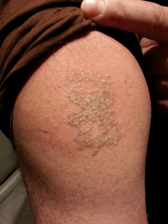 foto van voor en na de laserbehandeling tattoo verwijdering